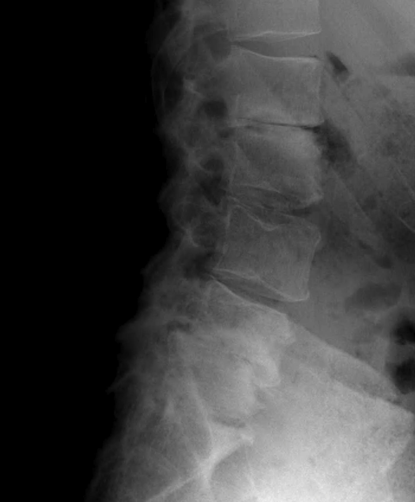 Lumbar Disc Degeneration Xray